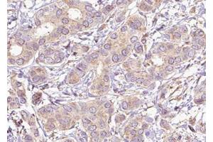 ABIN6267621 at 1/100 staining human Breast carcinoma tissue sections by IHC-P. (PTPN11 anticorps  (pTyr542))