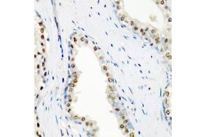 Immunohistochemistry of paraffin-embedded human prostate using SF3B3/S antibody (ABIN6128696, ABIN6147668, ABIN6147669 and ABIN6221751) at dilution of 1:200 (40x lens).