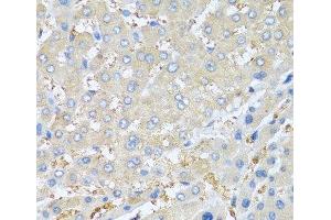 Immunohistochemistry of paraffin-embedded Human liver cancer using PPBP Polyclonal Antibody at dilution of 1:100 (40x lens). (CXCL7 anticorps)