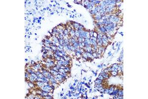 Immunohistochemistry of paraffin-embedded human colon carcinoma using COX IV Rabbit mAb (ABIN7266641) at dilution of 1:100 (40x lens). (COX IV anticorps)