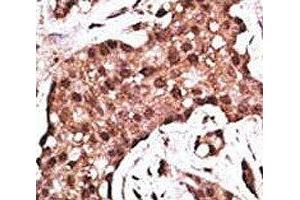 IHC analysis of FFPE human breast carcinoma tissue stained with the ATG5 antibody (ATG5 anticorps  (AA 1-30))