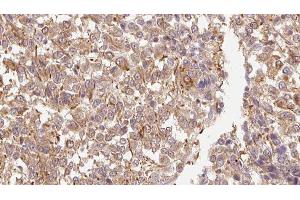 ABIN6278858 at 1/100 staining Human Melanoma tissue by IHC-P. (FGF11 anticorps  (Internal Region))