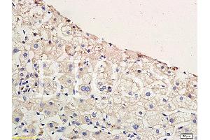 Formalin-fixed and paraffin embedded human hepatitides tissue labeled with Anti-CCR4 Polyclonal Antibody, Unconjugated (ABIN738666) at 1:200 followed by conjugation to the secondary antibody and DAB staining (CCR4 anticorps  (AA 201-300))