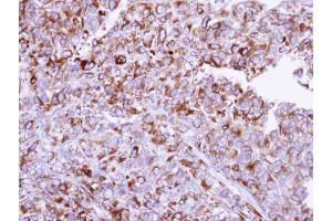 IHC-P Image Immunohistochemical analysis of paraffin-embedded CL1-0 xenograft, using HYOU1, antibody at 1:100 dilution.