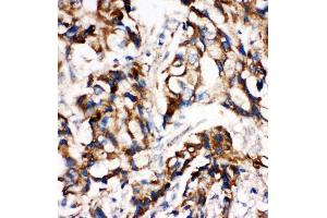 Anti-MEK1 antibody, IHC(P) IHC(P): Human Mammary Cancer Tissue
