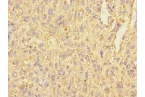 Immunohistochemistry of paraffin-embedded human melanoma using ABIN7174844 at dilution of 1:100 (C3ORF36 anticorps  (AA 1-165))