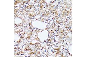 Immunohistochemistry of paraffin-embedded human mammary cancer using SLC7 antibody (ABIN7270481) at dilution of 1:100 (40x lens). (SLC7A2 anticorps  (C-Term))