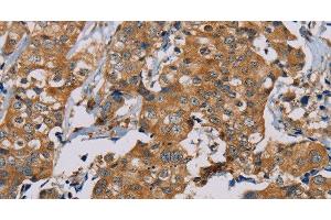 Immunohistochemistry of paraffin-embedded Human thyroid cancer using TAB3 Polyclonal Antibody at dilution of 1:35