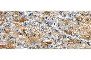 Immunohistochemistry of paraffin-embedded Human liver cancer using UPP2 Polyclonal Antibody at dilution of 1/35 (UPP2 anticorps)