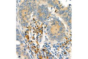 Immunohistochemistry of paraffin embedded human colon cancer using P4H (ABIN7074215) at dilution of 1:700 (400x lens) (HIF Prolyl Hydroxylase anticorps)