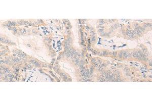 Immunohistochemistry of paraffin-embedded Human thyroid cancer tissue using ELANE Polyclonal Antibody at dilution of 1:25(x200) (ELANE anticorps)