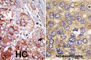 Formalin-fixed and paraffin-embedded human hepatocellular carcinoma tissue reacted with PFKFB4 polyclonal antibody  , which was peroxidase-conjugated to the secondary antibody, followed by AEC staining. (PFKFB4 anticorps  (Internal Region))
