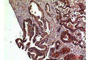 Immunohistochemistry (IHC) analysis of paraffin-embedded Human Prostate Cancer, antibody was diluted at 1:100. (RSAD2 anticorps  (Internal Region))