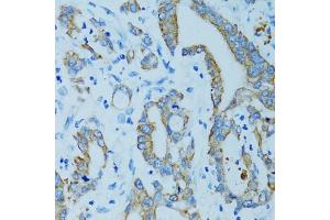 Immunohistochemistry of paraffin-embedded human colon carcinoma using KRT15 antibody (ABIN5971439) at dilution of 1/100 (40x lens). (KRT15 anticorps)