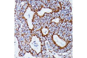 Immunohistochemistry of paraffin-embedded human colon carcinoma using IDH3A antibody (ABIN7268029) at dilution of 1:100 (40x lens).
