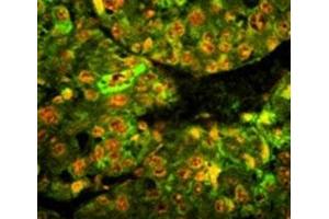 Immunofluorescence analysis of CD38 antibody with paraffin-embedded human hepatocarcinoma tissue. (CD38 anticorps  (AA 241-270))