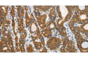 Immunohistochemistry of paraffin-embedded Human thyroid cancer tissue using PRDX5 Polyclonal Antibody at dilution 1:40