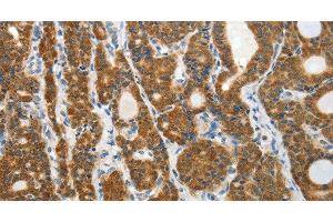Immunohistochemistry of paraffin-embedded Human thyroid cancer tissue using PRDX5 Polyclonal Antibody at dilution 1:40 (Peroxiredoxin 5 anticorps)