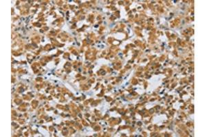 The image on the left is immunohistochemistry of paraffin-embedded Human thyroid cancer tissue using ABIN7190689(FOXF1 Antibody) at dilution 1/25, on the right is treated with synthetic peptide.