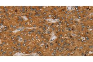 Immunohistochemistry of paraffin-embedded Human liver cancer tissue using PARP3 Polyclonal Antibody at dilution 1:40