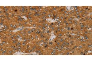 Immunohistochemistry of paraffin-embedded Human liver cancer tissue using PARP3 Polyclonal Antibody at dilution 1:40 (PARP3 anticorps)