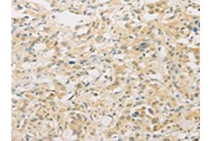 The image on the left is immunohistochemistry of paraffin-embedded Human thyroid cancer tissue using ABIN7129533(FNTA Antibody) at dilution 1/30, on the right is treated with fusion protein. (FNTA anticorps)
