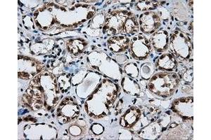 Immunohistochemical staining of paraffin-embedded Adenocarcinoma of ovary tissue using anti-FAHD2A mouse monoclonal antibody. (FAHD2A anticorps)