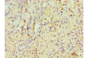 Immunohistochemistry of paraffin-embedded human lung cancer using ABIN7171955 at dilution of 1:100 (ERCC2 anticorps  (AA 1-300))