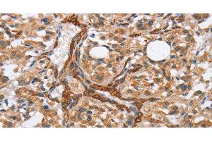 Immunohistochemistry of paraffin-embedded Human thyroid cancer tissue using BUB1 Polyclonal Antibody at dilution 1:50 (BUB1 anticorps)