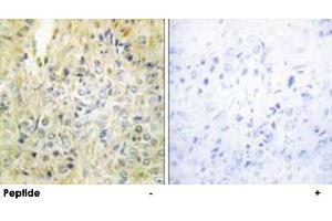Immunohistochemistry analysis of paraffin-embedded human prostate carcinoma tissue, using DLEC1 polyclonal antibody .