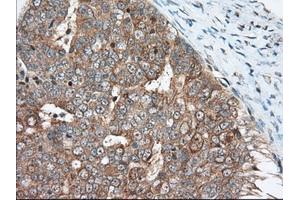 Immunohistochemical staining of paraffin-embedded Adenocarcinoma of Human breast tissue using anti-MIOX mouse monoclonal antibody. (MIOX anticorps)