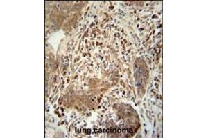 TAG antibody (Center) 10962c immunohistochemistry analysis in formalin fixed and paraffin embedded human lung carcinoma followed by peroxidase conjugation of the secondary antibody and DAB staining. (TAGAP anticorps  (AA 103-129))