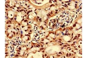 Immunohistochemistry of paraffin-embedded human lung cancer using ABIN7153896 at dilution of 1:100