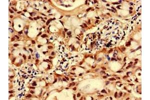 Immunohistochemistry of paraffin-embedded human lung cancer using ABIN7153896 at dilution of 1:100 (GNPNAT1 anticorps  (AA 1-184))
