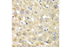Immunohistochemistry of paraffin-embedded human liver injury using CALD1 antibody (ABIN5973102) at dilution of 1/100 (40x lens). (Caldesmon anticorps)