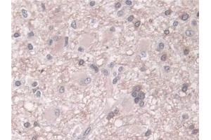 Detection of PLD in Human Glioma Tissue using Polyclonal Antibody to Phospholipase D (PLD)