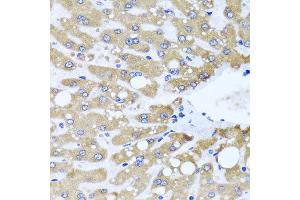 Immunohistochemistry of paraffin-embedded human liver injury using NDUFS3 antibody at dilution of 1:100 (x40 lens). (NDUFS3 anticorps)