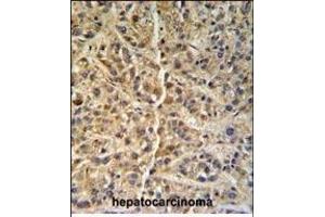 GNS Antibody (Center ) (ABIN390493 and ABIN2840852) IHC analysis in formalin fixed and paraffin embedded human hepatocarcinoma followed by peroxidase conjugation of the secondary antibody and DAB staining.