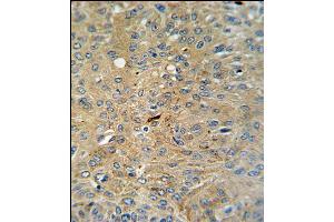 Cleaved-CASP3 (Asp175)Antibody (ABIN650861 and ABIN2839812) IHC analysis in formalin fixed and paraffin embedded human lung carcinoma followed by peroxidase conjugation of the secondary antibody and DAB staining.