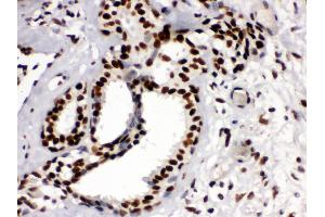 Anti-KAP1 Picoband antibody, IHC(P) IHC(P): Human Mammary Cancer Tissue