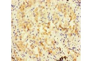 Immunohistochemistry of paraffin-embedded human lung cancer using ABIN7152480 at dilution of 1:100 (FBXL21 anticorps  (AA 78-137))