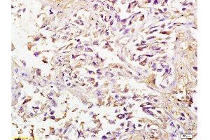 Formalin-fixed and paraffin embedded human lung carcinoma labeled with Anti-SPARC Polyclonal Antibody, Unconjugated  at 1:200 followed by conjugation to the secondary antibody and DAB staining.