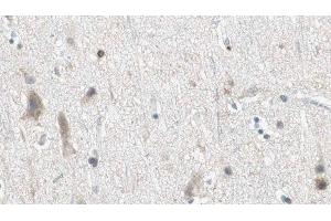 ABIN6275086 at 1/100 staining Human brain cancer tissue by IHC-P. (DZIP3 anticorps  (Internal Region))