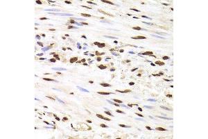Immunohistochemistry of paraffin-embedded human gastric cancer using HNRNPD Antibody.