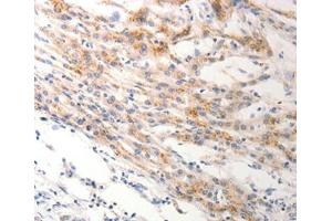 Immunohistochemical analysis of paraffin-embedded Human lung cancer tissue using at dilution 1/0. (Keratin 6B anticorps  (Internal Region))