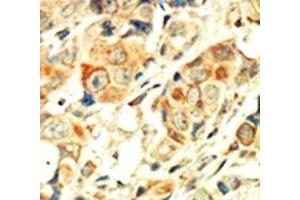 IHC analysis of FFPE human breast carcinoma tissue stained with the PKC alpha antibody (PKC alpha anticorps  (AA 299-329))