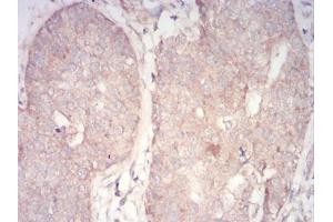Immunohistochemical analysis of paraffin-embedded bladder cancer tissues using PDPK1 mouse mAb with DAB staining.