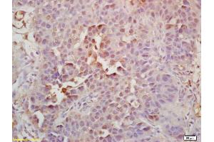 Formalin-fixed and paraffin embedded human bladder carcinoma labeled with Rabbit Anti Geminin Polyclonal Antibody, Unconjugated (ABIN1387623) at 1:200 followed by conjugation to the secondary antibody and DAB staining (Geminin anticorps  (AA 110-142))