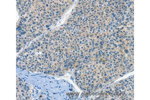 Immunohistochemistry of Human liver cancer using HID1 Polyclonal Antibody at dilution of 1:50 (HID1/DMC1 anticorps)