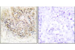 Immunohistochemistry analysis of paraffin-embedded human breast carcinoma tissue using TCTP antibody. (TPT1 anticorps)